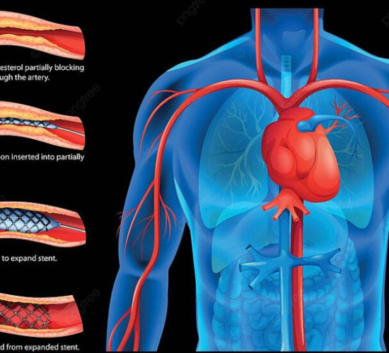 Coronary Angioplasty & Stenting Procedure