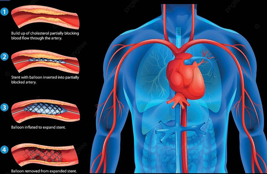 Coronary Angioplasty & Stenting Procedure