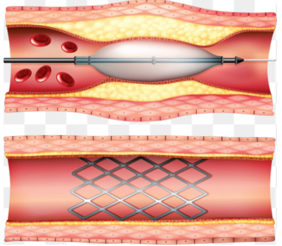 Before & After Image: Coronary Artery Blockage vs. Open Artery